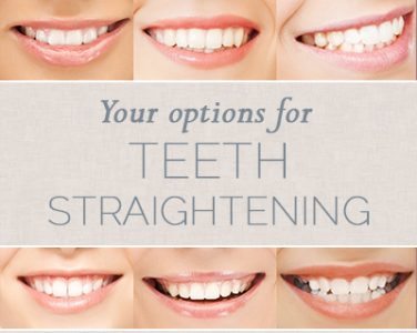 Your Options for Teeth Straightening - <p>Maybe Mona Lisa would have cracked a real smile if she had been more confident in her teeth! All jokes aside, you don’t have to live every day embarrassed by your own smile. Orthodontic treatments today are much more desirable than those of yesteryear. There are a lot of good reasons to straighten your teeth, […]</p>
