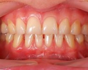 Gum Disease Symptoms to Look For - <p>There is no excerpt because this is a protected post.</p>
